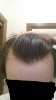 hairloss7.jpg
