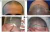 asimetria alopecia frontal.JPG