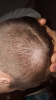 Hair whorl, thinningornot.png