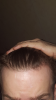 Hairline,norwood1-2.png