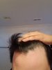 hair loss 7.jpg