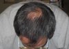 9-22-10 Four Feet Flas Start finasteride.JPG