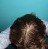 Crown - After minoxidil application.gif
