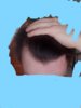 hairloss3.jpg