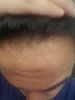 frontal_hairline.jpg