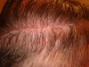 hair transplant #3 4 MO POST-OP 001.jpg