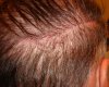 hair transplant #3 4 MO POST-OP 003.jpg