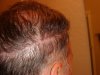 hair transplant #3 4 MO POST-OP 010.jpg