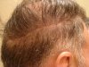 hair transplant #3 4 MO POST-OP 013.jpg