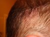 hair transplant #3-POST-OP-DAY 6-staples.jpg