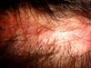 hair transplant #1-POST-OP-SCAR-60 DAYS-1.jpg