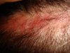 hair transplant #1-POST-OP-SCAR-60 DAYS-2.jpg