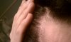 old hairline close up.jpg