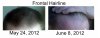 Frontal Hairline.jpg