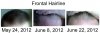 Frontal Hairline.jpg
