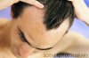 M1080579-Baldness-SPL.jpg