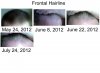 Frontal Hairline.jpg