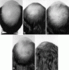 Androgenetic Alopecia.gif