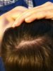 Bald spot hair pulling.JPG