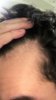 JULY LEFT SIDE INFLAMMATION (IN HAIRLINE HARD TO SEE).jpg