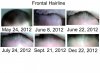 Frontal Hairline.jpg