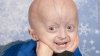 t1larg.progeria.jpg