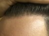10 months hairline 2.jpg