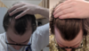 12 months hairline.png