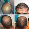bald collage.jpg