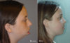 before-after-jaw-surgery.jpg