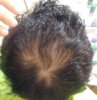 hair tranplant 2.jpg