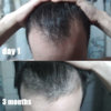 HairLossTalk.com--Dermarol-MIN-finasteride.jpg HairLossTalk.com--Dermarol-MIN-finasteride.jpg