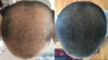 HairLossTalk.com--Derma-MIN-Nizoral.jpg HairLossTalk.com--Derma-MIN-Nizoral.jpg