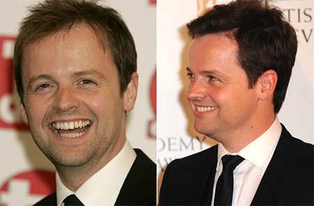 declan-donnelly-hair-transplant.jpg