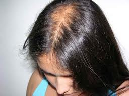 alopecia%20(2)_1.jpg