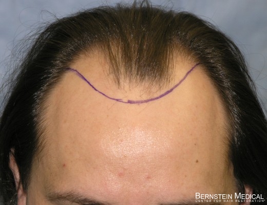 04_position-of-hairline.jpg