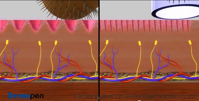 derma+roller+vs.jpg