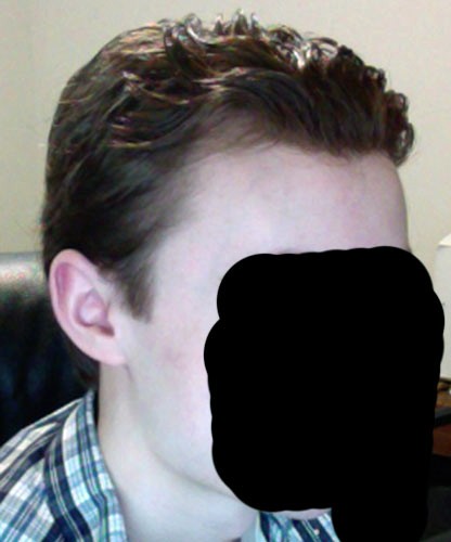 afterloweredhairline.jpg