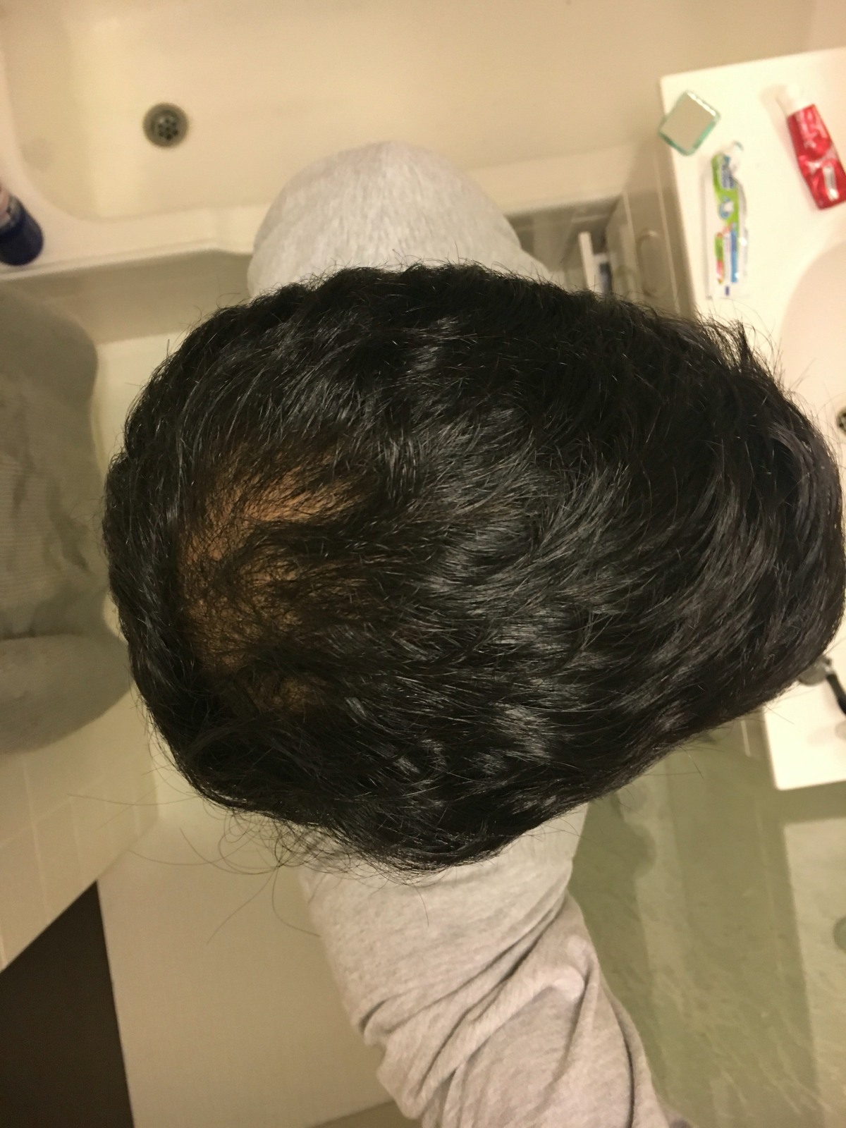 can i stop using minoxidil after 3 months