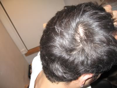 hairloss3.jpg