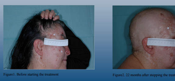 alopeciashh.jpg