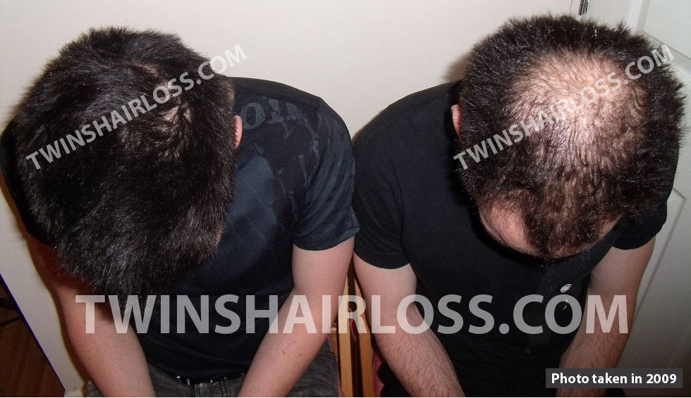 twins-hair-loss-comparison-photo-2.jpg