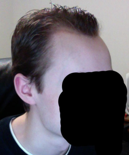 beforeloweredhairline.jpg