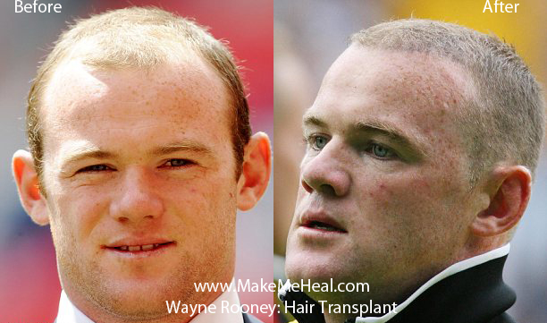 wayne-rooney-plastic-surgery.jpg