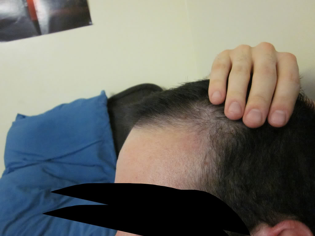 hairloss01.jpg