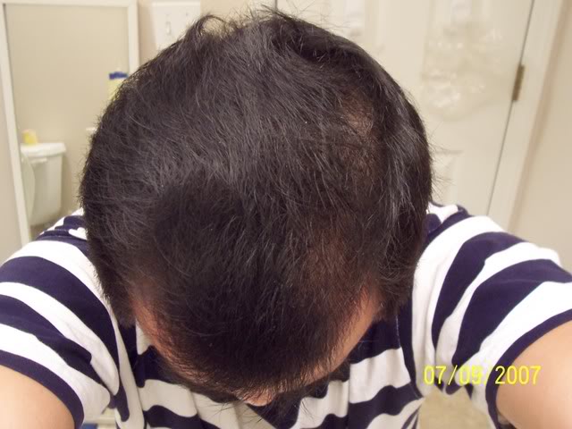 Rogaine once-a-day foam application with pics | HairLossTalk Forums