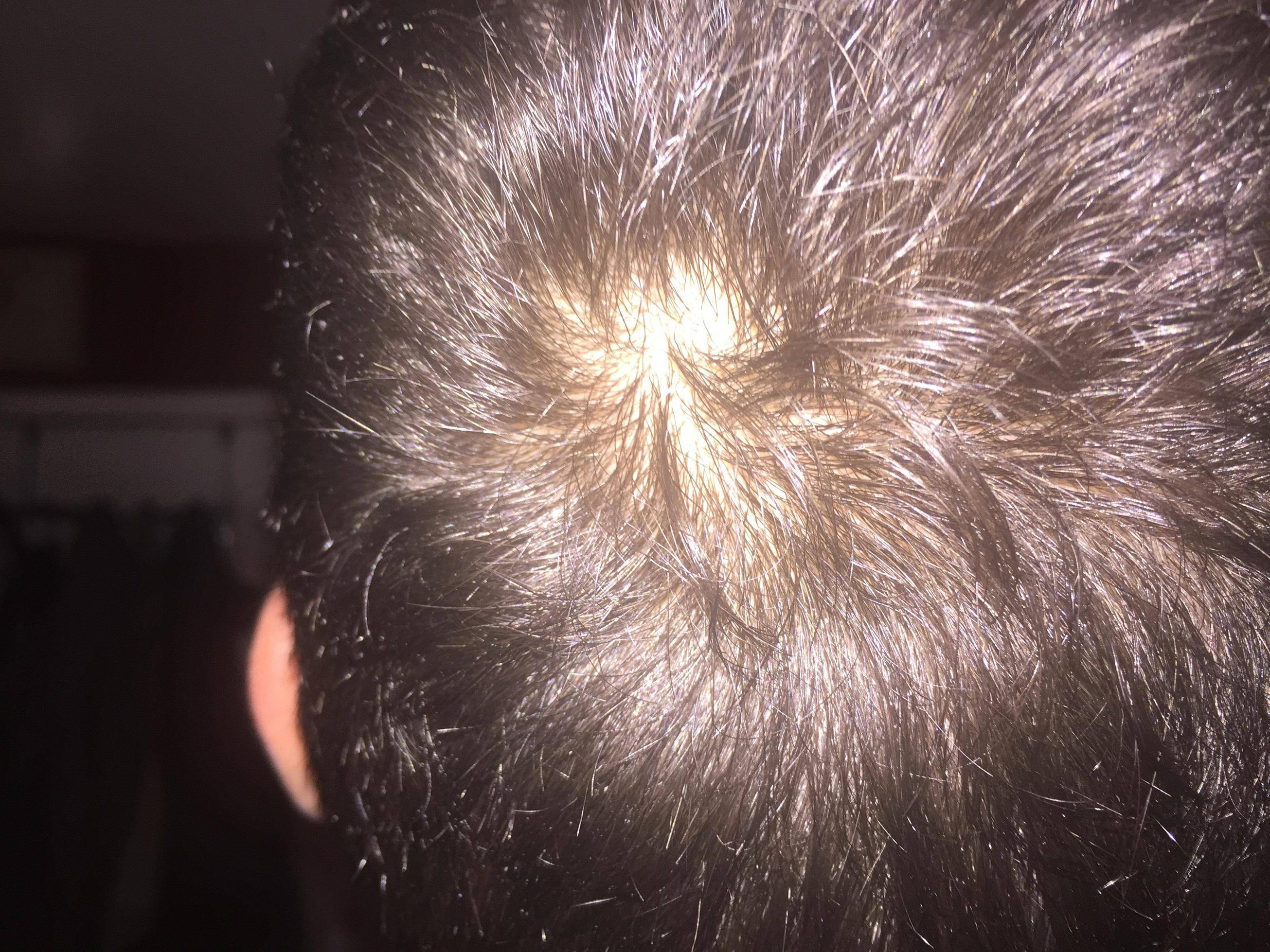 Am I Balding Bald Spot On Crown And Worried Hairlosstalk Forums
