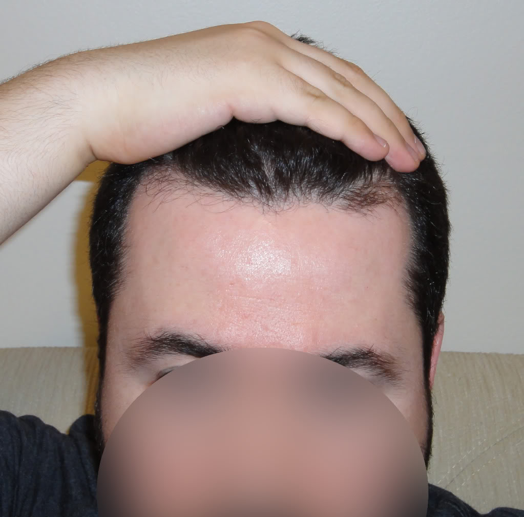 knowhair-hairline-exposed.jpg