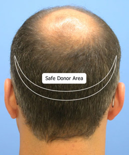 hair-donor-area.jpg