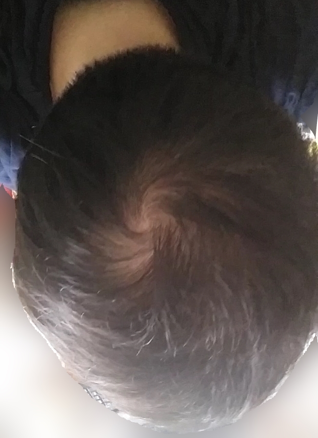 Noticed A Bald Spot At The Crown Of Head HairLossTalk Forums